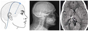 Diagram, sagittal head radiography, and axial head CT scan showing the trajectory of the stimulation electrode through the craniotomy to its insertion in the thalamus, in a patient with refractory trigeminal neuralgia secondary to multiple sclerosis (Hospital de la Santa Creu i Sant Pau).