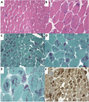 (A) Haematoxylin-eosin stain. Presence of rimmed vacuoles (left) and numerous muscle fibres with irregular eosinophilic sarcoplasmic inclusions occupying a large part of the fibres. (B) Close-up of the image displayed in A. (C and D) Gomori trichrome stain displaying red-staining nemaline structures. (E) Close-up image of rod-like nemaline structures. (F) The immunohistochemical study showed nemaline rods containing actin filaments.