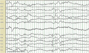 EEG showing diffuse encephalopathy with high-voltage rhythmic delta waves in bilateral central regions and vertex.