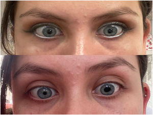 Top: symmetrical pupils. Bottom: left pupil is mydriatic and dyscoric. Photographs were taken by the patient.