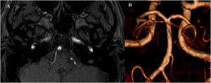 Axial 3D TOF MRI angiography sequence performed at 3 months, showing a linear filling defect in the inferior third of the basilar artery (A) and a reconstruction showing this alteration, which may correspond to an incomplete fenestration (B).
