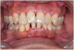 Example of a patient with periodontitis.