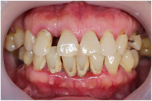 Example of a patient with moderate periodontitis.