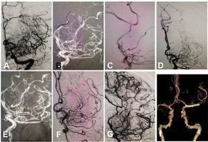 A patient in their 50s with hyperlipidemia had arterial occlusion at the M1 segment of the left middle cerebral artery (MCA) and the A2 segment of the left anterior cerebral artery (ACA). (A) Arterial occlusion was shown at left M1 and A2 segments. (B) A micro-guidewire was navigated through the A2 occlusion site into distal branches. (C) After angioplasty, a Solitaire AB stent was deployed. (D) After stent deployment, the A2 segment was recanalized, but the M1 segment remained occluded. (E) A micro-guidewire was navigated across the M1 occlusion into the distal branch. (F) After balloon angioplasty, a LVIS stent was deployed. (G) After stenting, the M1 segment was revascularized. (I) At one year, the A2 and M1 segments remained patent.