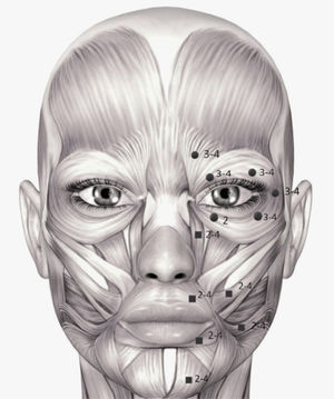 Schematic diagram of injection site and dosage of botulinum toxin A. Take the spasm of the left hemifacial muscle, including orbicularis oculi muscle, zygomatic muscle, orbicularis oris muscle, and mental muscle, as an example. Round: Required injection site; Square:Alternative injection site.