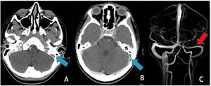 Axia CTV (A and B) showing a filling defect in the left transverse and sigmoid sinuses (blue arrows); (C) MRV (3D reconstruction) obtained 7 months later in the same patient shows subtotal recanalization of the previously thrombosed sinuses (red arrow).