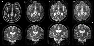 Axial and frontal views of a postoperative 3D T2-weighted MRI (A) and 1 month (B), 1 year (C) and 3 years (D) MRI controls showing left MRI-guided focused ultrasound (MRIgFUS) thalamotomy. L (left side). R (right side).