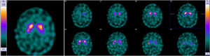 Neuroimaging from index case in family #3. DaT-SPECT showed a mild decrease, not significant, in the density of presynaptic transporters of dopamine in neurons of the left putamen.
