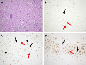 Main neuropathological features of index case from family #4. A) Marked depletion of motor neurons from the anterior horn of the spinal cord (hematoxylin and eosin stain). B) Motor neuron filiform cytoplasmic inclusion was revealed by anti–TDP-43 in the spinal cord (black arrow). Other remaining motor neurons showed loss of normal nuclear staining (red arrows). C) Many small cortical neuronal paranuclear inclusions were detected with antibodies against TDP-43 (black arrows). Short cortical dystrophic neurites were observed with anti–TDP-43 (black arrowheads) Loss of normal nuclear staining of TDP-43 was noted (red arrows). D. Some hippocampal neuronal cytoplasmic inclusions in dentate granule cells were displayed (black arrows). Loss of normal nuclear staining of TDP-43 was noted (red arrow). Magnification ×400.
