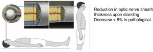 Transorbital ultrasound study. Adapted from Fichtner et al.63