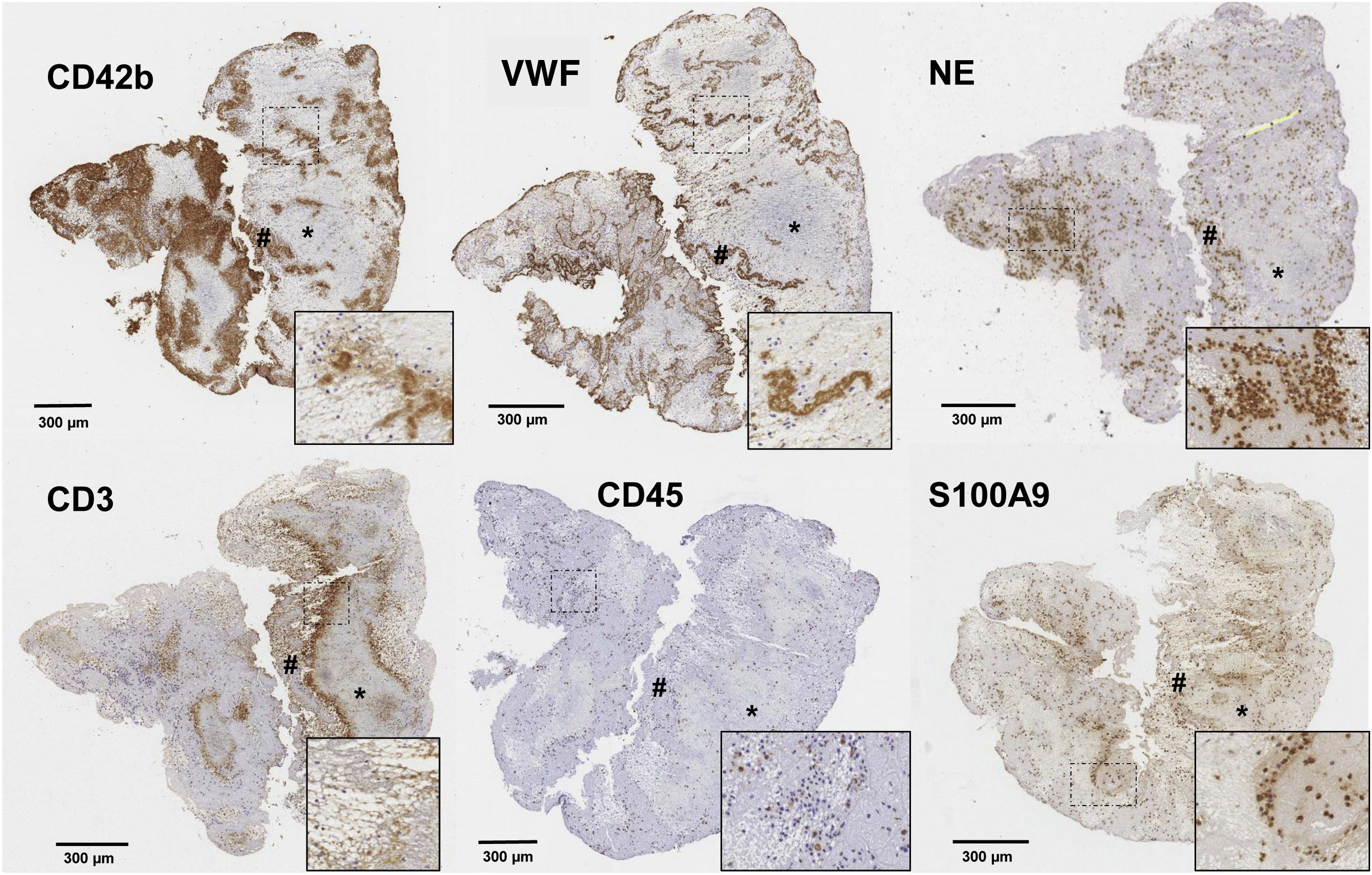 Nebraska Cd3 Thrombus composition and its implication in ischemic stroke assessment ...