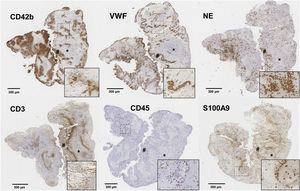 Histological sections of an ischaemic stroke thrombus with specific immunostaining for Cd42b+ platelets, von Willebrand factor, neutrophil elastase (NE), CD3+ lymphocytes, CD45+ leukocytes, and calprotectin (S100A9). Platelet-rich areas are marked with asterisks (*) and erythrocyte-rich areas with a hash sign (#). The marked areas are shown at 20× magnification in the lower right corner of each image. Source: Atherothrombosis Laboratory, CIMA/Universidad de Navarra.