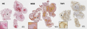 Histological sections of an ischaemic stroke thrombus stained with: haematoxylin and eosin (HE), Martius Scarlet Blue (MSB), and specific immunostaining for thrombin activatable fibrinolysis inhibitor (TAFI). Platelet-rich areas are marked with asterisks (*) and erythrocyte-rich areas with a hash sign (#). The marked areas are shown at 20× magnification in the lower right corner of each image. Source: Atherothrombosis Laboratory, CIMA/Universidad de Navarra.