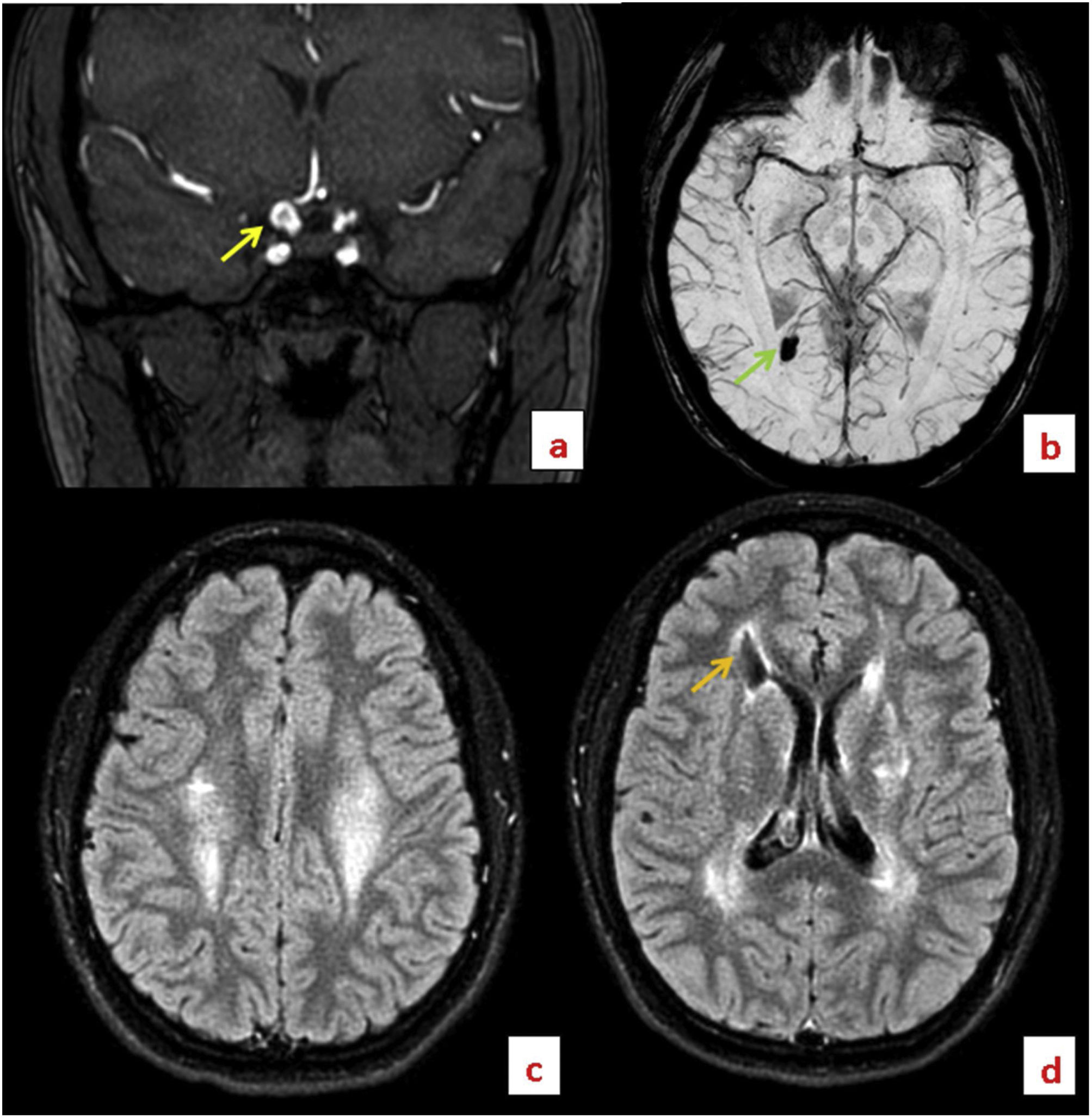 Mutations in the type IV collagen gen (COL4A1) as an unusual etiology ...