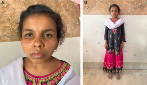 Examination reveals (A) a short-statured girl with extreme cachexia, microcephaly, senile look, loss of subcutaneous fat, and pinched nose, giving her a characteristic ‘Mickey Mouse’ appearance. The patient had hyperpigmented brown macules over the malar area with photosensitivity and scarring (B).