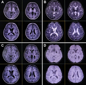 Magnetic resonance imaging of the brain reveals symmetrical hypomyelination of the hemispheric periventricular white matter with early ventricular dilatation, calcification of bilateral basal ganglia and thalamus, and dysgenesis of the corpus callosum (axial T1-weighted [A], T2-weighted [B], fluid-attenuated inversion recovery [C], and gradient echo sequences [D]).