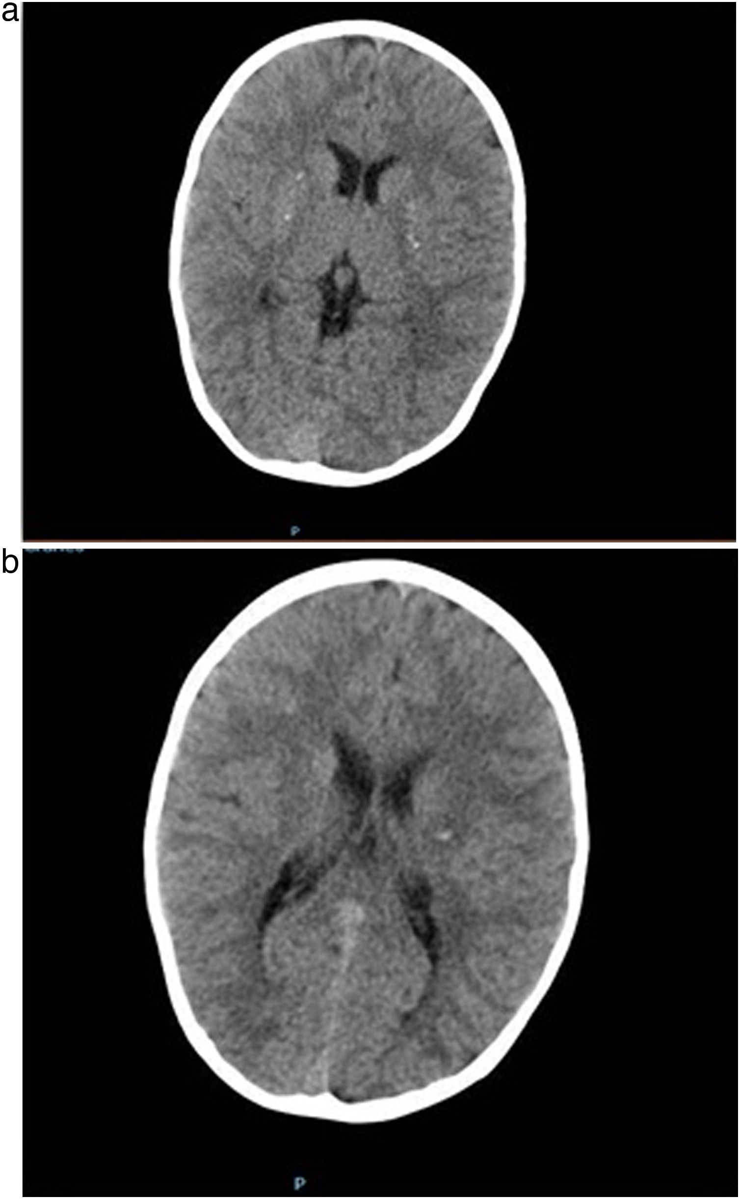Punctiform Infarction Mineralizing angiopathy: A cause of arterial ischemic stroke in early ...