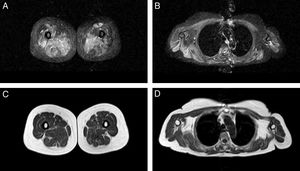 Whole-body muscle MRI study. In the thighs, T2-weighted STIR sequences (A) showed increased signal intensity in the adductor muscles in the medial compartment, vastus lateralis, and rectus femoris in the anterior compartment and biceps femoris in the posterior compartment, more predominantly on the right side. At the shoulder girdle level, increased signal intensity is observed in the periscapular and deltoid muscles, and less markedly in the pectoral muscles, with greater involvement on the right side (B). These changes were not accompanied by fatty replacement in T1-weighted turbo spin echo sequences (C and D).