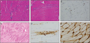 Muscle biopsy. Slices of striated muscle showing moderate variability in fibre size (A) with groups of atrophic angular fibres (asterisks), regenerative fibres (arrowheads), and occasional myophagocytosis (B; asterisks). Haematoxylin and eosin staining. ATPase 42 staining revealed presence of fibres of different types (B). Immunostaining showed positive CD-68 macrophages in the endomysium and inside muscle fibres (D), disperse positive CD-3 lymphocytes (E), and positive HLA-I labelling with deep staining of the membrane and small extension to the sarcoplasm (F).