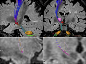 Model representing the approach used in this study to determine the treatment coordinates. The dentate nucleus is shown in yellow, the red nucleus in red, and the ventral intermediate nucleus in pink.
