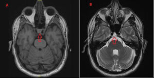 Follow-up MRI study performed 4 years later, showing the same lesion (red arrow) with identical size and characteristics on T1-weighted (A) and T2-weighted sequences (B). We observed no bone destruction or other signs of malignancy.