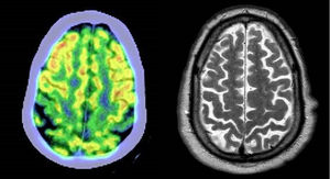 Patient 2. Left: axial slice from a brain 18F-FDG PET study, revealing bilateral perirolandic hypometabolism (motor band sign). Right: brain MRI showing an area of greater atrophy, coinciding with the area of hypometabolism in the left image.