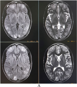 MRI of the brain revealing asymmetric bilateral T2-weighted and T2-fluid-attenuated inversion recovery sequences hyperintensities in the parietooccipital and frontal region with patchy diffusion restriction, suggestive of vasogenic edema (posterior reversible encephalopathy syndrome).