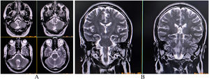 Contrast-enhanced magnetic resonance imaging of the brain revealing an altered intensity lesion hyper on axial T2-weighted imaging (T2-WI) (A) and coronal-T2-WI (B) involving the lateral aspect of the right half of the medulla.