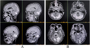 Contrast-enhanced magnetic resonance imaging of the brain revealing mildly asymmetrical involvement of bilateral cerebellar hemispheres and adjacent meninges with uniform contrast enhancement suggestive of infective cerebellitis (A, sagittal T1-weighted imaging; B, T1-weighted imaging).