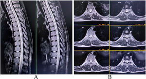 Contrast-enhanced MRI of the spinal cord revealing high signal intensity lesion and swelling extending from D4 to D5 level to distal cord region (A, mid-sagittal T2-weighted imaging; B, axial T2-weighted imaging) suggestive of longitudinally extensive transverse myelitis.
