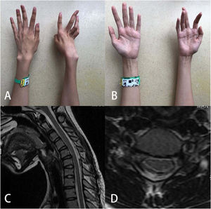 A 14-year-old girl whose menarche age was 13 complained of difficulty in extending fingers of the right hand (A and B). Loss of attachment was found in cervical-flexion magnetic resonance imaging (C and D).