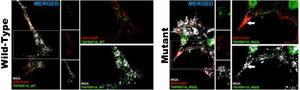Confocal microscopy images of cells transfected with the TNFRSF1A (WT gene) and the TNFRSF1A-R92Q (MT gene). The expression of EGFP coupled to the WT gene and mutant gene in HOG cells is observed, as well as the analysis of the expression of GRP78-BiP (endoplasmic reticulum [ER], protein involved in the correct folding of proteins and degradation of misfolded proteins) and WGA (membrane marking). It is interesting that the expression of TNFRSF1A (WT) was mainly in the cell membrane, whereas TNFRSF1A-R92Q (mutant) expression formed small precipitates in the endoplasmic reticulum (arrows), which are also positive for WGA; these possibly correspond to non-functional/misfolded protein inclusions in the cytoplasm, since GRP78-BiP, also known as HSPA5 (heat shock protein family A, member 5), is considered an essential ER chaperone and a master regulator of ER homeostasis. GRP78 facilitates the folding and assembly of nascent polypeptides, prevents their misfolding and aggregation, targets misfolded proteins for proteasome degradation, and controls signaling for the initiation of the various arms of the unfolded protein response.