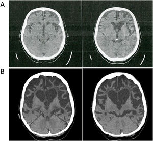 Neuroimaging from index case in family #1. CT brain scan showing severe and asymmetric atrophy of the frontal and temporal lobes, more intense on the left side. A) Baseline, at diagnosis. B) Follow-up, 5 years after diagnosis.