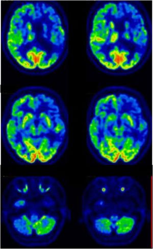 Neuroimaging from case index in family #2. Brain FDG-PET scan showing severe hypometabolism in the left frontal, temporal, and parietal cortices, as well as in the left caudate, putamen, and thalamus nuclei and the right cerebellar cortex.