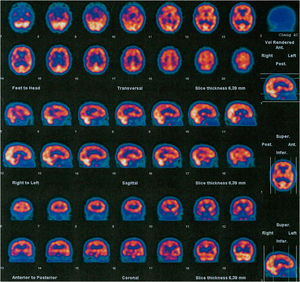 Neuroimaging study from case index in family #5. SPECT brain scan showed mild-moderate hypoactivity in the frontotemporal regions, more marked on the right hemisphere, and irregularities in the perfusion of parietal lobes.