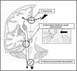 The main pathophysiological hypotheses for the development of ipsilateral hemiparesis.2 Schematic representation of a coronal section of the brain: the dotted line represents the projection of the right corticospinal tract, with decussation at the level of the junction between the medulla oblongata and the spinal cord (the large arrowhead indicates the crossed pyramidal tract whereas the small arrowhead indicates the direct pyramidal tract). 1) Theory of brain dysfunction caused by a remote brain lesion, proposed by the Mauritian physiologist and neurologist Charles-Édouard Brown-Séquard14 (1817-1894), which served as the basis for the concept of diaschisis proposed by Constantin von Monakow (1853-1930). According to this concept, in the context of ipsilateral hemiparesis, a brain lesion affecting the primary motor area of the dominant hemisphere (black lightning symbol) may cause contralateral motor dysfunction secondary to impaired communication through the commissural fibres of the corpus callosum (black dashed arrow). 2) Kernohan-Woltman notch phenomenon.3 Brainstem displacement (solid black arrow) resulting in a groove in the cerebral peduncle caused by compression against the tentorial notch; it may be associated with a structural lesion to the corticospinal tract (dotted line and black arrows). 3) Theory of the lack of decussation of corticospinal tract fibres,11 demonstrated with the anatomoclinical method proposed by Albert Pitres (1848-1928) and Jean-Martin Charcot (1825-1893).