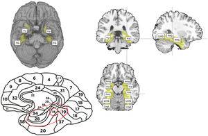 Brain areas used for inclusive masking in the memory paradigm. (A) Caudal projection of the brain, with activation of both hippocampi and fusiform gyri (FG). (B) Lateral projection of the brain, showing the Brodmann areas included in the analysis (B16, 16, 36, 37). (C) Top left: coronal slice showing the bilateral hippocampi included in the paradigm. Top right: sagittal slice showing the parahippocampal gyrus (PHG), parahippocampus (PHC), and lingual gyrus (LinG). Bottom: axial slice showing anatomical areas included in the memory mask. In anteroposterior order: amygdala (Amyg), hippocampus (Hip), parahippocampal gyrus (PHG), lingual gyrus (LinG), and lingual lobe (LingL).