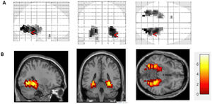 Brain activation of a patient with left mesial temporal lobe epilepsy under the memory paradigm. (A) Three projections from the activation map obtained using the memory paradigm: sagittal, coronal, and axial planes, respectively. The higher P-values (darker tone) in voxels in the right hemisphere (red arrow) represent greater levels of activation. (B) The same projections, with the voxels activated by the memory paradigm; colour values closer to yellow represent higher levels of activation.