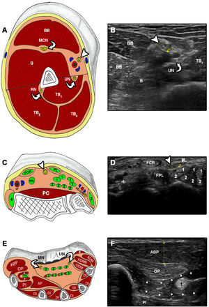 Cross-sectional ultrasound imaging and anatomical correlations of the upper limb. A and B) MN at the level of the upper arm. B: brachialis; BB: biceps brachii; MCN: musculocutaneous nerve; RN: radial nerve; TB: triceps brachii; UN: ulnar nerve. Arrowhead: median nerve. C and D) FCR: flexor carpi radialis; FPL: flexor pollicis longus; PC: pronator quadratus; PL: palmaris longus; rb: radial neurovascular bundle; ub: ulnar neurovascular bundle; UN: ulnar nerve. 1: flexor digitorum superficialis; 2: flexor digitorum profundus; 3: flexor carpi ulnaris; 4: brachioradialis. Arrowhead: median nerve. E and F) ABP: abductor pollicis brevis; ADM: abductor digiti minimi; AP: adductor pollicis; DI: dorsal interossei; FDMB: flexor digiti minimi brevis; FPL: flexor pollicis longus; MN: median nerve; ODM: opponens digiti minimi; OP: opponens pollicis; PI: palmar interossei; UN: ulnar nerve; 1: flexor pollicis longus; 2: flexor digitorum superficialis; 3: flexor digitorum profundus; 4: palmaris brevis. Asterisk: flexor pollicis brevis.