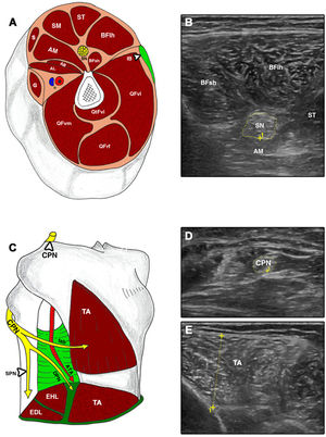 Cross-sectional ultrasound imaging and anatomical correlations of the lower limb. A and B) AB: adductor brevis; AL: adductor longus; AM: adductor magnus; BFlh: long head of the biceps femoris; BFsh: short head of the biceps femoris; G: gracilis; IB: iliotibial band; QFrf: quadriceps femoris – rectus femoris; QFvi: quadriceps femoris – vastus intermedius; QFvl: quadriceps femoris – vastus lateralis; QFvm: quadriceps femoris – vastus medialis; S: sartorius; SM: semimembranosus; SN: sciatic nerve; ST: semitendinosus. C–E) ATA: anterior tibial artery; CPN: common peroneal nerve; DPN: deep peroneal nerve; EDL: extensor digitorum longus; EHL: extensor hallucis longus; SPN: superficial peroneal nerve; TA: tibialis anterior; tab: tibialis anterior branch.