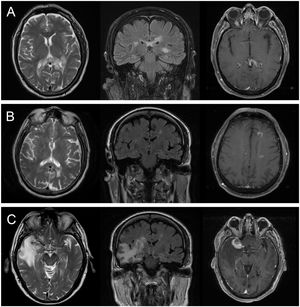 Brain MRI scan from patient 1. A) T2-weighted and FLAIR sequences showing a hyperintense lesion in the corpus callosum. B) Decrease in the size of the lesion at 6 months of follow-up. C) Development of a new lesion in the right temporal lobe, showing contrast uptake and increased intensity on T2-weighted and FLAIR sequences, at 18 months of follow-up.21