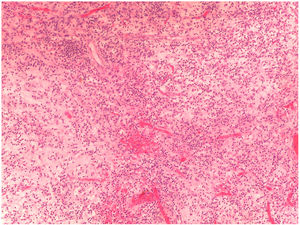 Histopathological findings from a brain biopsy of patient 1. Chronic inflammation of intracerebral and leptomeningeal vessels, around the vascular walls.21