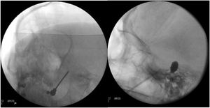 A) A thermal radiofrequency (thermocoagulation) electrode inserted via the foramen ovale in a patient with refractory trigeminal neuralgia of the V3 branch (Waters view). B) Cannula carrying a size 4 Fogarty balloon (shown inflated), inserted through the foramen ovale in an 84-year-old female patient with trigeminal neuralgia affecting the V2 branch (Hospital de la Santa Creu i Sant Pau).