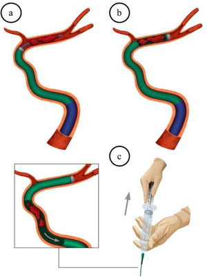 Embed aspiration technique. a) NeuronMax™ 088 is inserted as distally as possible in the internal carotid artery. The SOFIA™ 6 F/5 F aspiration catheter is advanced to the occlusion, using a Rebar™ 0.027″/0.021″ microcatheter and a Transend™ 0.014″ guidewire. b) The aspiration catheter is placed over the whole thrombus with the aim of capturing it at once. c) The microcatheter and guidewire are removed after the SOFIA™ catheter is placed. Manual aspiration is performed with a directly connected 60 mL VacLock™ syringe.