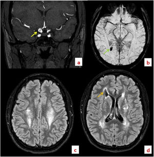 MRI scans. a) Coronal 3D time-of-flight sequence showing a saccular aneurysm (yellow arrow) on the terminal segment of the right intracranial internal carotid artery. b) Axial SWI sequence showing a focus of paramagnetic susceptibility (green arrow) in the right peritrigonal region, corresponding to a chronic-subchronic haemorrhagic focus. c) Axial FLAIR sequence showing hyperintense lesions in both corona radiata, in association with leukoencephalopathy. d) FLAIR sequence showing hyperintense lesions in periventricular areas, as well as in the adjacent deep subcortical white matter, compatible with leukoencephalopathy. A porencephalic cyst (orange arrow) is also present.