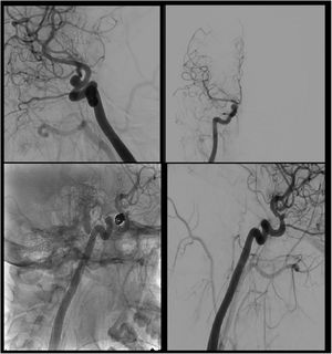Cerebral angiography study. The top images are from the diagnostic arteriography in the late arterial phase: oblique view (first image) and anteroposterior view (second image). The third and fourth images show the embolisation of the aneurysm with coils.