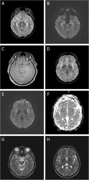 Contrast-enhanced brain MRI study performed at disease onset, showing bilateral hippocampal hyperintensities on T2/FLAIR sequences (A), restricted diffusion (B), and lack of contrast uptake (C). The study also revealed hyperintense lesions in the external capsules on T2/FLAIR sequences (D), with restricted diffusion (hyperintense on diffusion-weighted imaging [E] and hypointense on the apparent diffusion coefficient map [F]). Contrast-enhanced brain MRI study performed at 8 months of follow-up, showing resolution of T2 hyperintensities in the hippocampi (G) and external capsules (H).