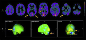 18F-FDG PET study. A) Axial images showing hypometabolism in the thalamus, predominantly right temporo-parieto-occipital junction, and right cerebellar hemisphere (yellow arrows). B) 3D-stereotactic surface projection maps comparing these findings against data from healthy patients of the same age group, which confirm our conclusions. Areas of hypometabolism are indicated in blue.