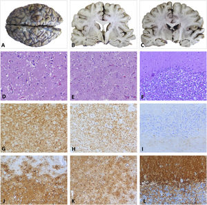 Post mortem histopathological examination. A–C) Macroscopic study. Images of the whole brain and coronal sections at the level of basal ganglia and thalamus, revealing slight atrophy of the temporal cortex, without other significant changes. D, G, J) Parietal cortex. Neuronal loss and moderate neuropil spongiosis, with small-/medium-sized rounded vacuoles observed with HE staining (D). The immunohistochemical study revealed PrP deposition with a diffuse granular-synaptic pattern (G), as well as marked reactive astrogliosis detected by GFAP staining (J). E, H, K) Thalamus. HE (E) and GFAP staining (K) revealed neuronal loss with minimal spongiosis and severe astrogliosis. Prp deposition in the thalamus was less marked than in the cortex (H). F, I, L) Cerebellum. Moderate loss of granule neurons and Purkinje cells observed with HE staining (F), with small foci of PrP in the granular layer (I) and astrogliosis detected with GFAP (L). GFAP: glial fibrillary acidic protein; HE: haematoxylin-eosin; PrP: prion protein.