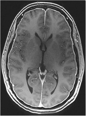 Diffuse, homogeneous pachymeningeal enhancement in the brain MRI study of a 42-year-old woman with spontaneous intracranial hypotension confirmed with cerebrospinal fluid manometry in a lumbar puncture procedure. Courtesy of Dr. Belvís. Neurology department, Hospital de la Santa Creu i Sant Pau. Barcelona.